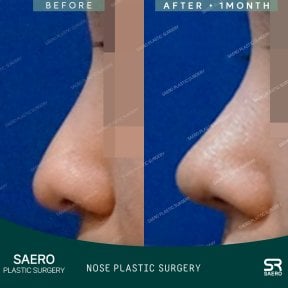 Vorher-nachher-Ergebnisse der geschlossenen Nasenkorrektur bei SAERO Plastic Surgery, verbesserte Nasenform