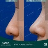 Vorher-nachher-Ergebnisse der geschlossenen Nasenkorrektur bei SAERO Plastic Surgery, verbesserte Nasenform