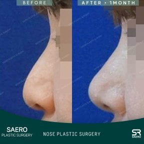 Vorher-nachher-Ergebnis der geschlossenen Rhinoplastik bei SAERO Plastic Surgery, verbesserte Nasenform