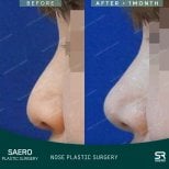 Vorher-nachher-Ergebnis der geschlossenen Rhinoplastik bei SAERO Plastic Surgery, verbesserte Nasenform