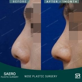 Vorher-nachher-Ergebnisse der geschlossenen Rhinoplastik bei SAERO Plastic Surgery, verbesserte Nasenform