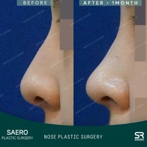 Vorher-nachher-Ergebnisse der geschlossenen Rhinoplastik bei SAERO Plastic Surgery, verbesserte Nasenform
