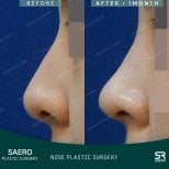 Vorher-nachher-Ergebnisse der geschlossenen Rhinoplastik bei SAERO Plastic Surgery, verbesserte Nasenform