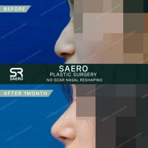 Before and after osteotomy rhinoplasty results at SAERO Plastic Surgery, nose reshaping
