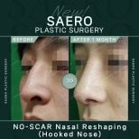 Before and after no-scar osteotomy rhinoplasty for hooked nose at SAERO Plastic Surgery