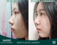 Результати остеотомії ринопластики до і після в SAERO Plastic Surgery, покращений профіль носа