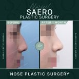 Результати остеотомії ринопластики до і після в SAERO Plastic Surgery, покращений профіль носа