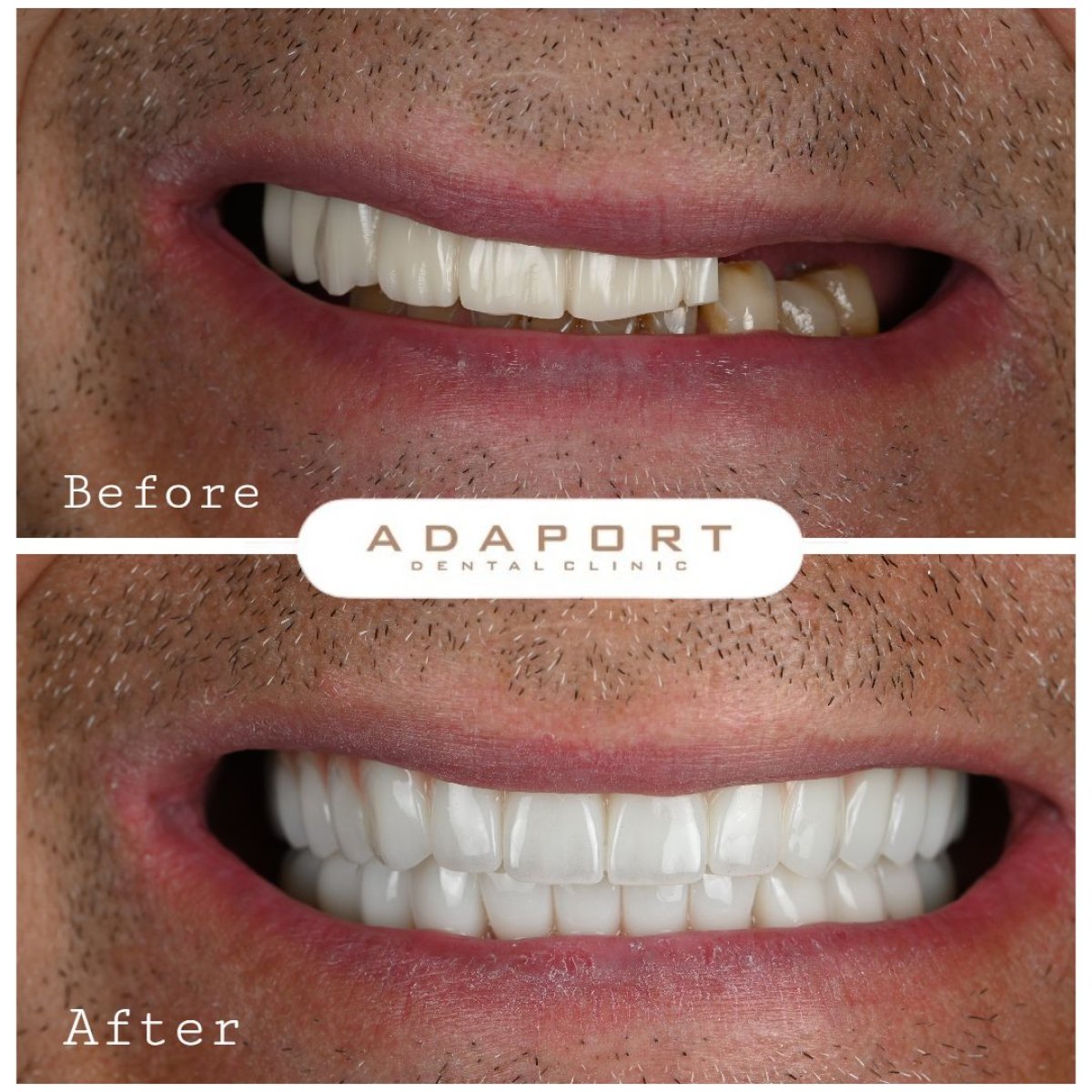 Resultados antes y después de implantes All-on-6 en Adaport Dental Clinic, restauración de sonrisa
