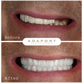 Before and after All-on-6 dental implants result at Adaport Dental Clinic, smile restoration