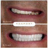 Before and after All-on-6 dental implants result at Adaport Dental Clinic, smile restoration