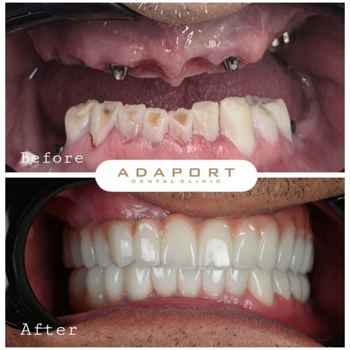 Resultados antes y después de implantes dentales All-on-6 en Adaport Dental Clinic, sonrisa restaurada