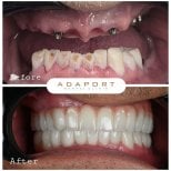 Before and after All-on-6 dental implants result at Adaport Dental Clinic, full smile restoration