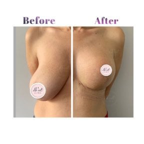 before-after photo mastopexy-breast-lift-contour-plastics