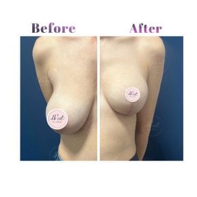 before-after photo mastopexy-breast-lift-contour-plastics