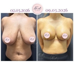 before-after photo mastopexy-breast-lift-contour-plastics