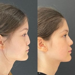 before-after photo rhinoplasty-nose-job