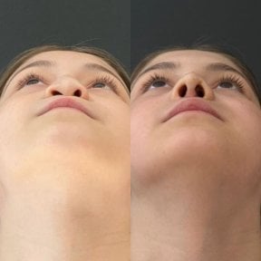 before-after photo rhinoplasty-nose-job