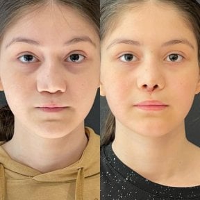 before-after photo rhinoplasty-nose-job