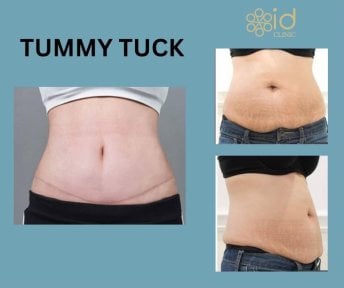 before-after photo mastopexy-breast-lift-contour-plastics