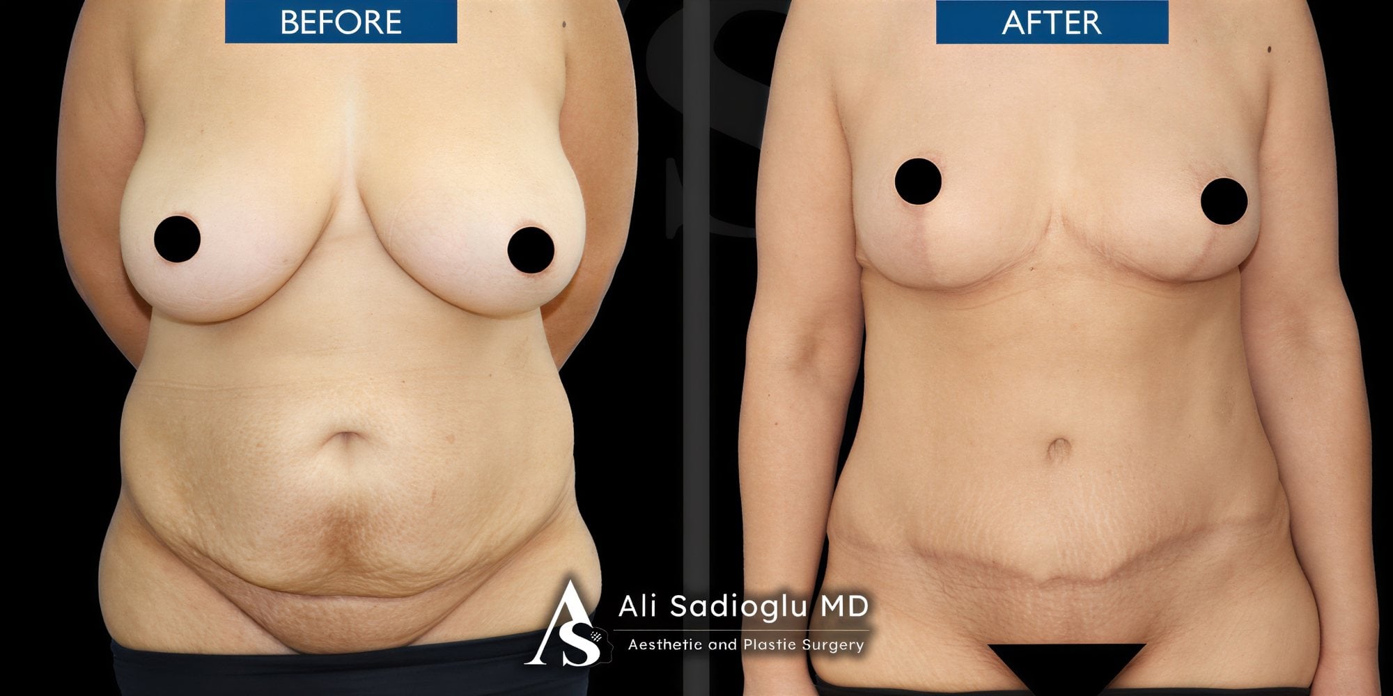 Resultados antes y después de reducción de senos en Dr. Safa Manav Clinic, forma mejorada