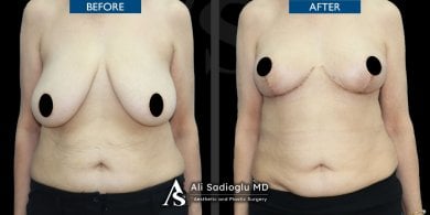 before-after photo breast-reduction
