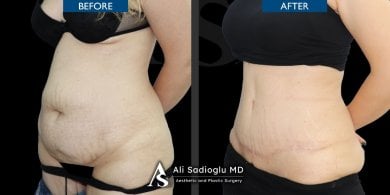 before-after photo breast-reduction