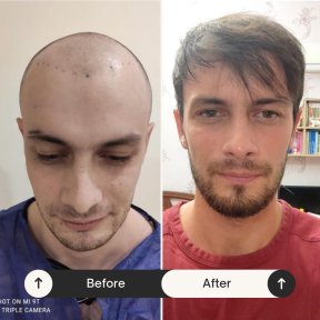 Résultat avant et après greffe de cheveux FUE à Istanbul Hair Indonesia, ligne capillaire restaurée