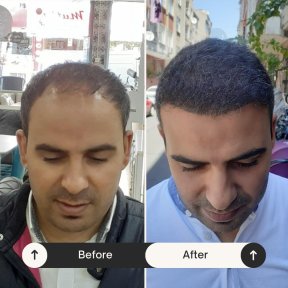 Résultats avant et après greffe de cheveux FUE chez Istanbul Hair Indonesia, ligne restaurée