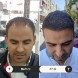 Résultats avant et après greffe de cheveux FUE chez Istanbul Hair Indonesia, ligne restaurée