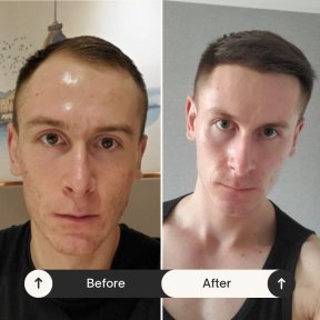 Résultats avant et après greffe de cheveux DHI chez Istanbul Hair Indonesia, densité accrue