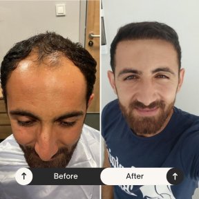Résultats avant et après greffe de cheveux DHI chez Istanbul Hair Indonesia, ligne restaurée