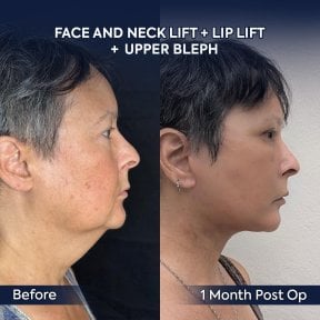 before-after photo deep-plane-facelift