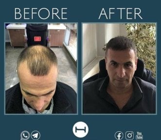 before-after photo beard-transplantation
