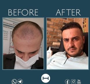 before-after photo beard-transplantation