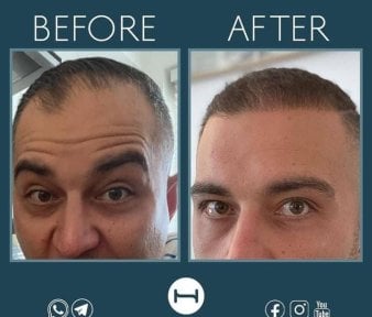 before-after photo beard-transplantation