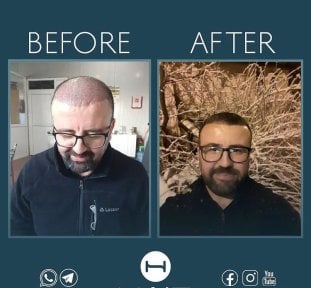 before-after photo beard-transplantation