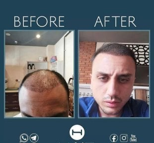 before-after photo beard-transplantation