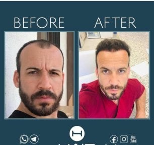 before-after photo beard-transplantation