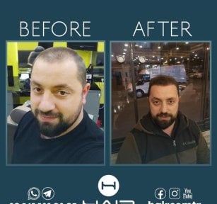 before-after photo beard-transplantation