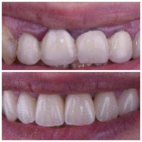 Результат до и после виниров в Dentaland Premium Luxury Clinic & Academy, улучшенная улыбка