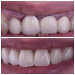Результат до и после виниров в Dentaland Premium Luxury Clinic & Academy, улучшенная улыбка