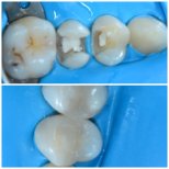 Résultats avant et après restauration dentaire (bonding) à Dentaland Premium Luxury Clinic & Academy