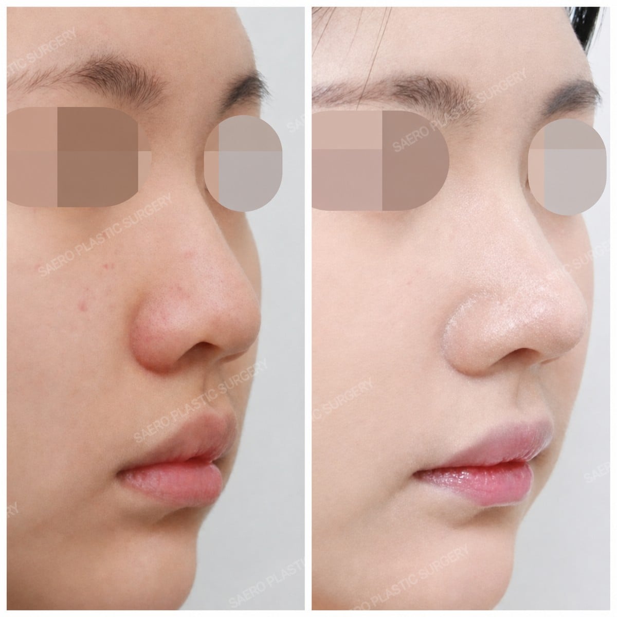 نتائج قبل وبعد عملية تجميل الأنف المغلقة في SAERO Plastic Surgery، تحسين شكل الأنف