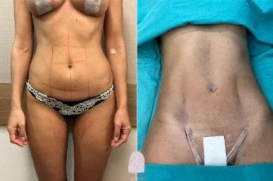 before-after photo liposculpture