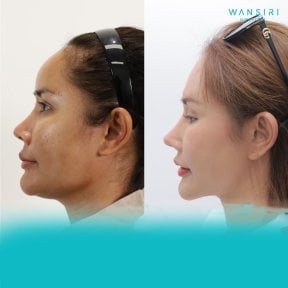before-after photo double-chin-liposuction