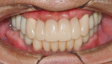before-after photo dental-implant