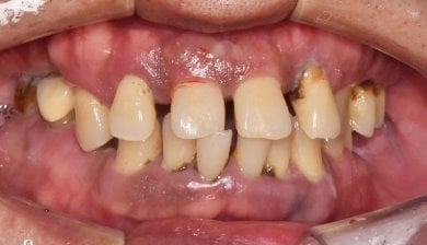 before-after photo dental-implant