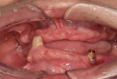 before-after photo dental-implant