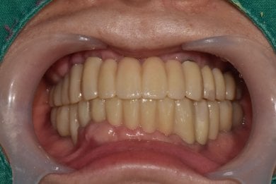 before-after photo dental-implant