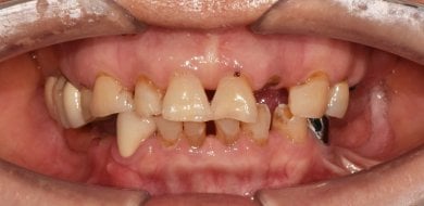 before-after photo dental-implant